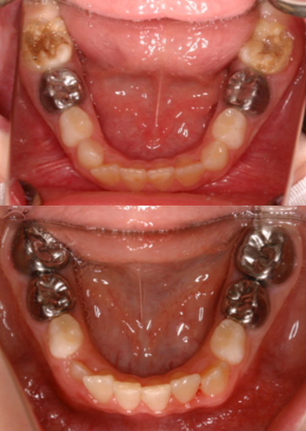 Preformed stainless steel crowns stabilise affected teeth Preformed stainless steel crowns stabilise affected teeth